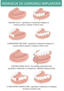 Indikacije za ugradnju implantata